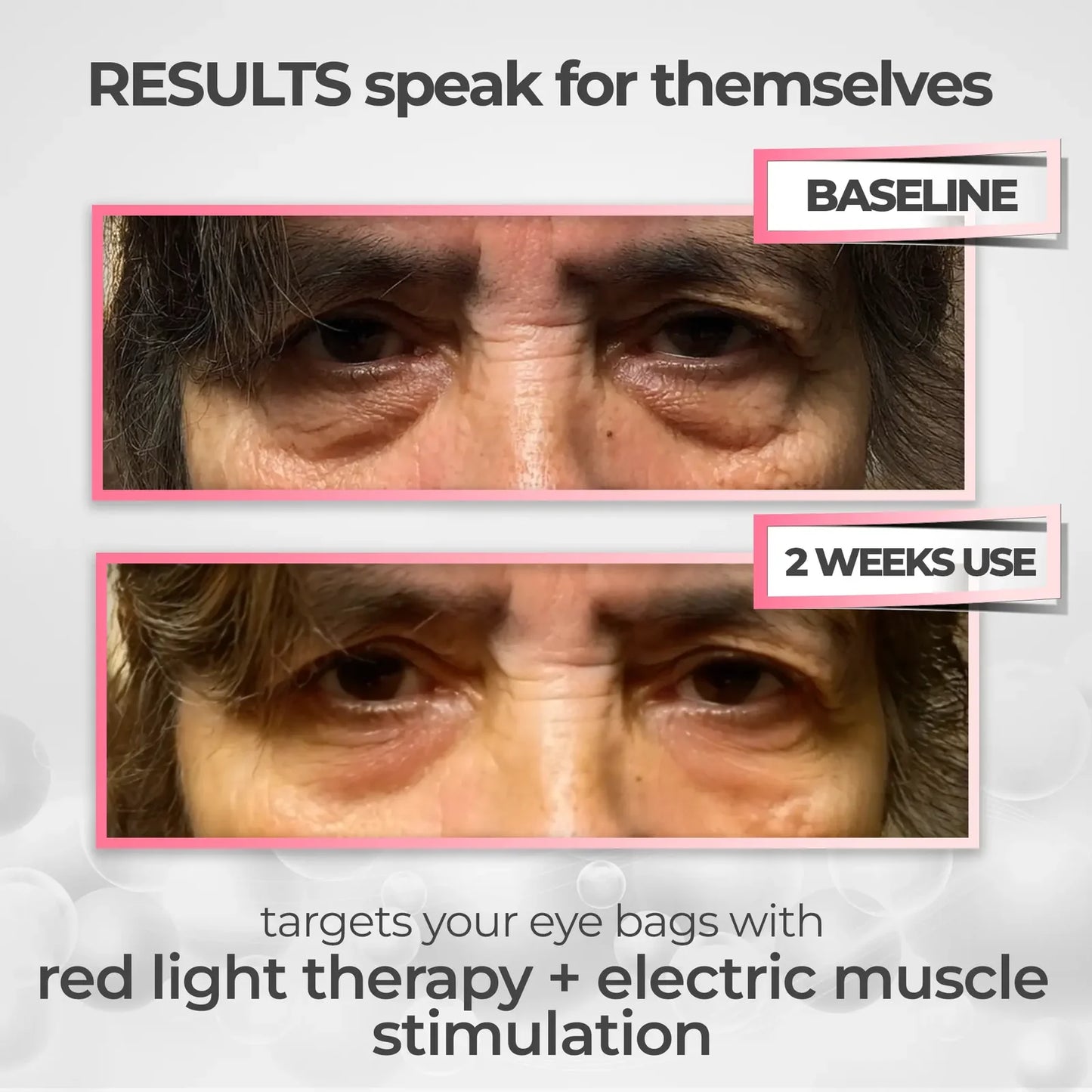 RestorEyes™ 3-in-1 Red Light + EMS + Lymphatic Therapy