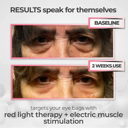 RestorEyes™ 3-in-1 Red Light + EMS + Lymphatic Therapy